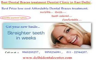Dental Braces Delhi