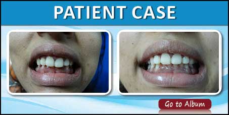 Dental Braces Case Photos