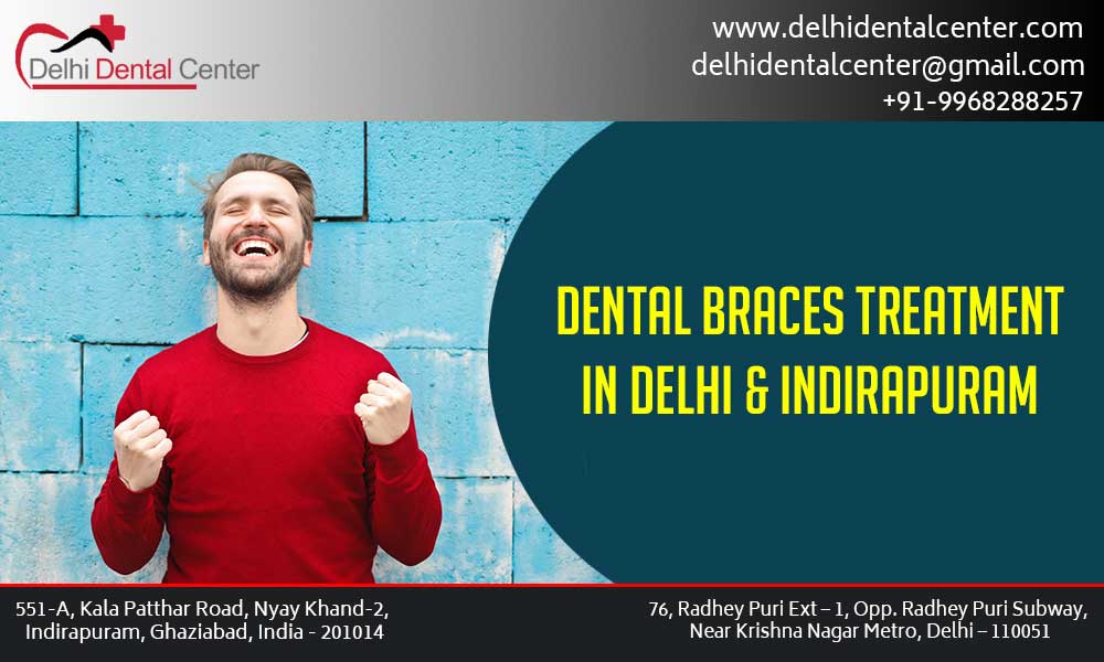 Dental Braces in Delhi