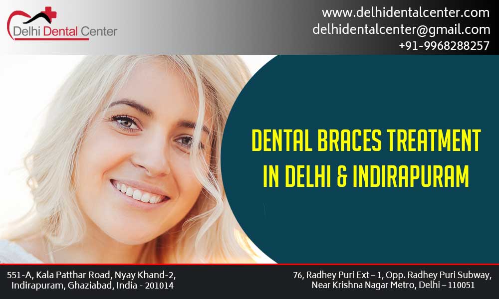 Dental Braces in Delhi