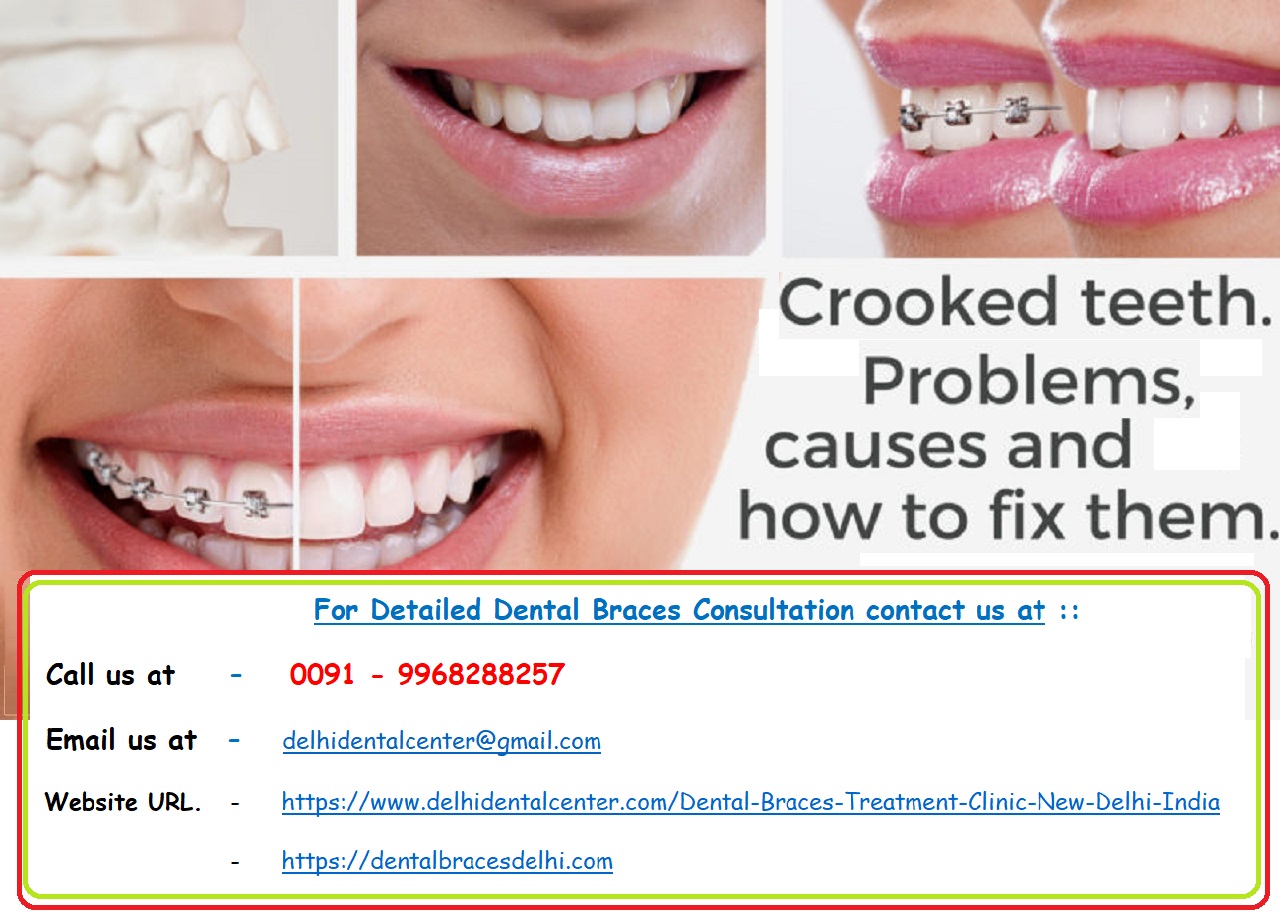 Dental Braces Treatment in Delhi. Dental Braces Treatment Clinic Delhi