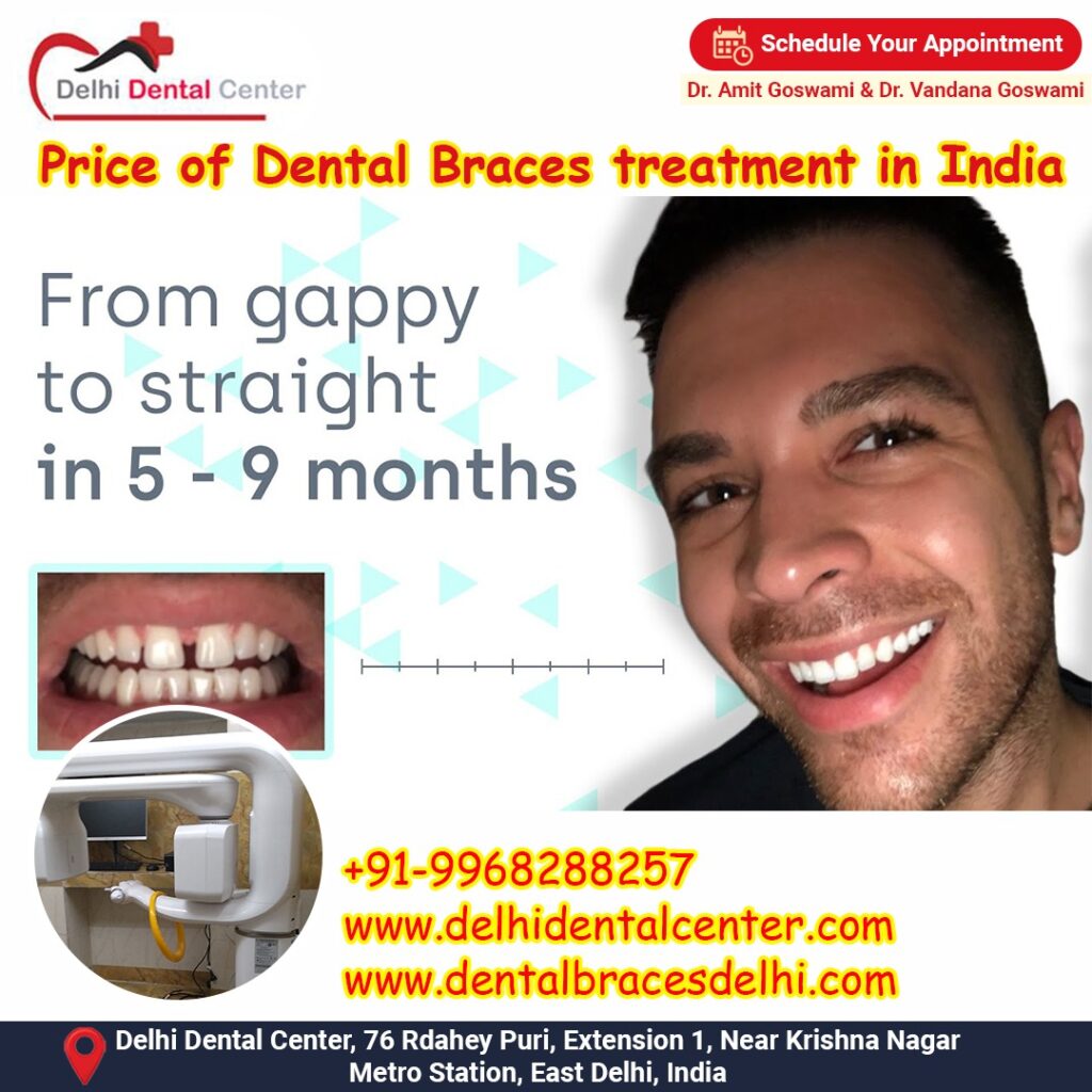Best top Painless Adult Invisible Dental Braces Aligners Treatment, Best Price Dental Braces treatment in India