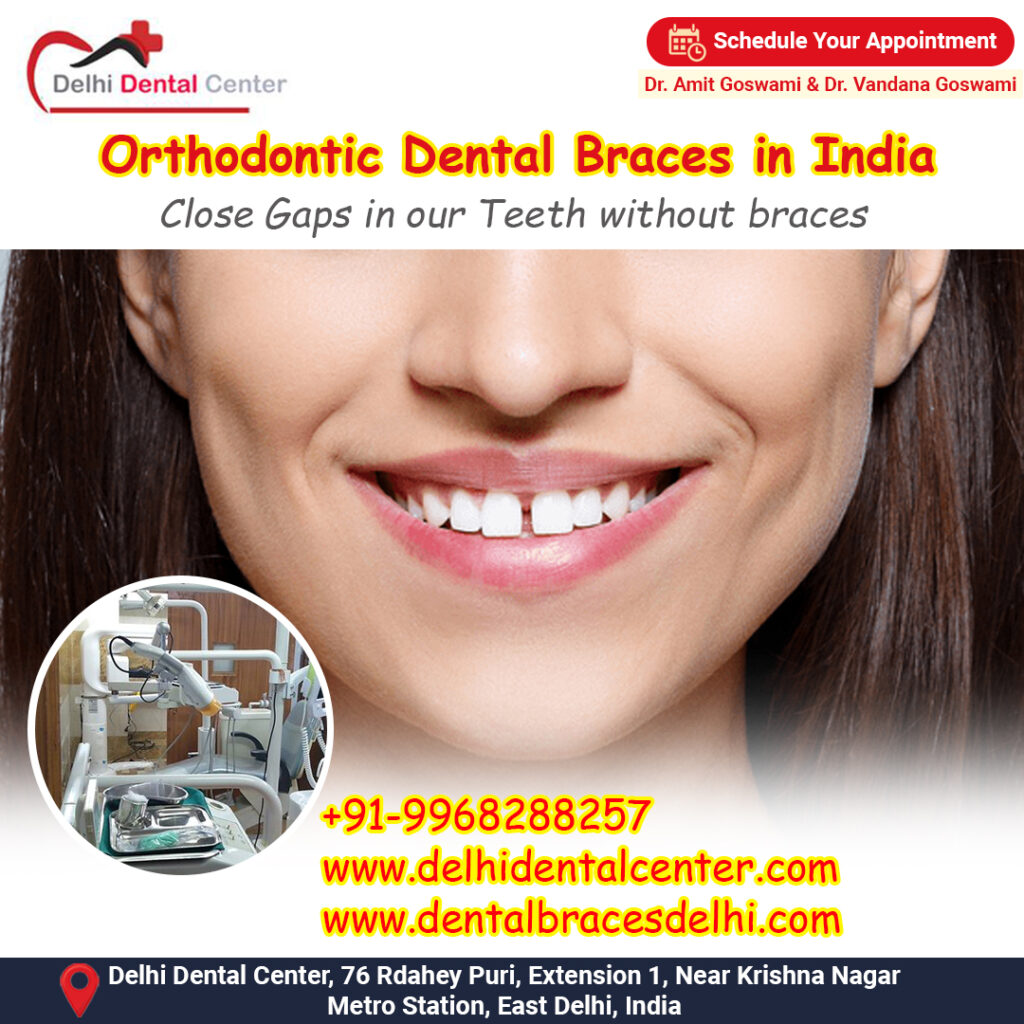 Best top Painless Adult Invisible Dental Braces Aligners Treatment, Dental Braces India